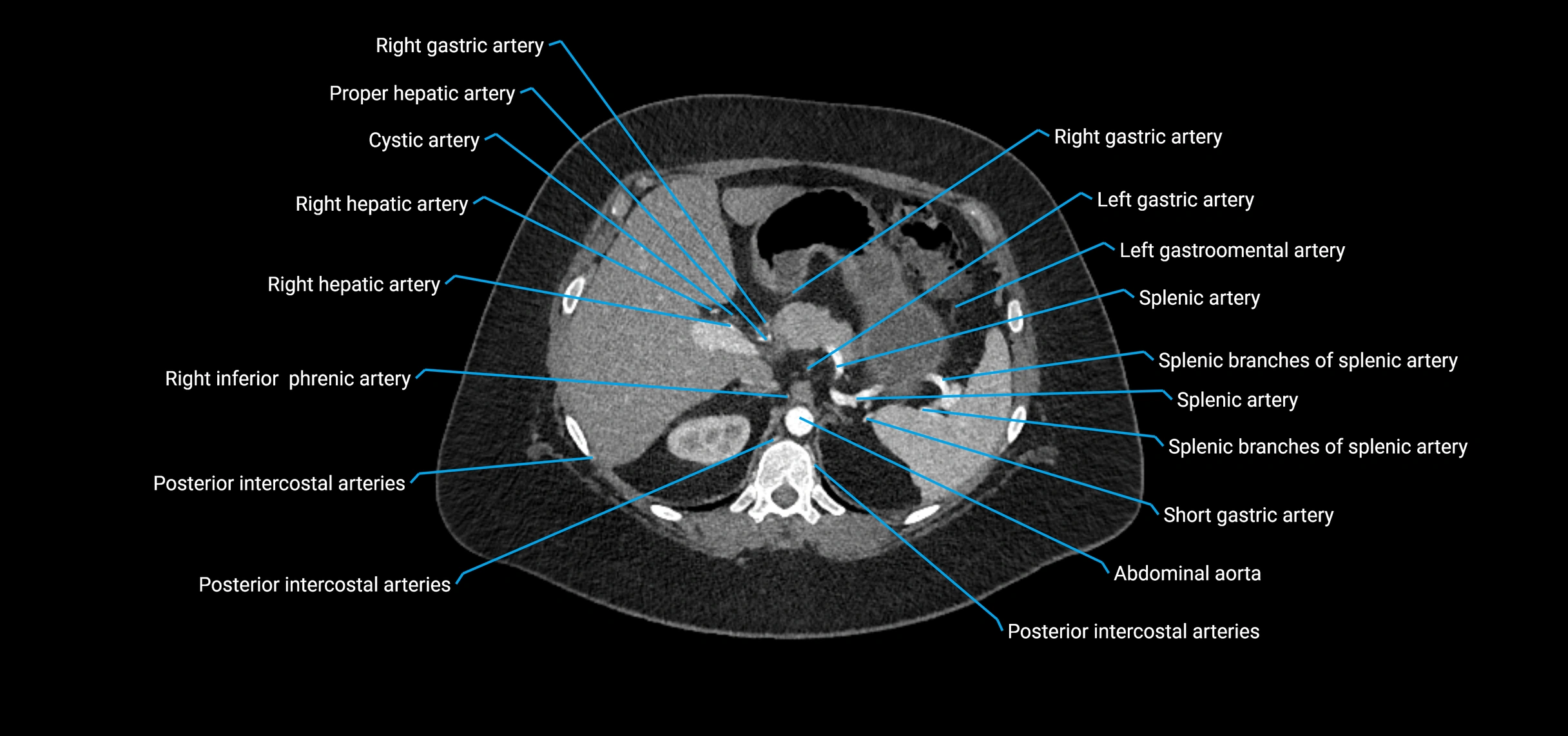 CTA abdomen axial cross sectional anatomy labelled image_46 (2).webp